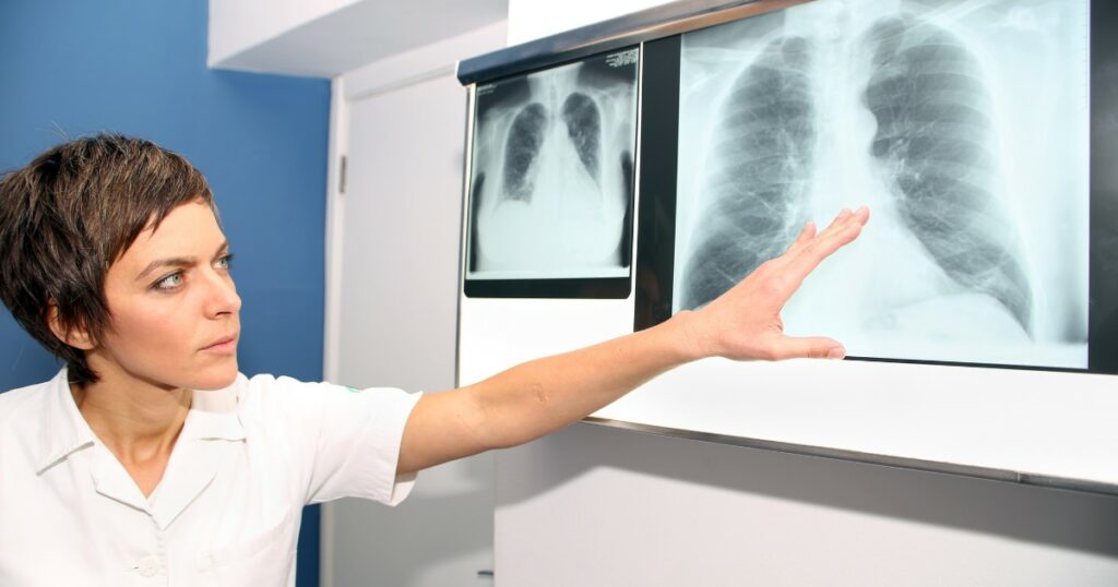 Pulmonary Embolism