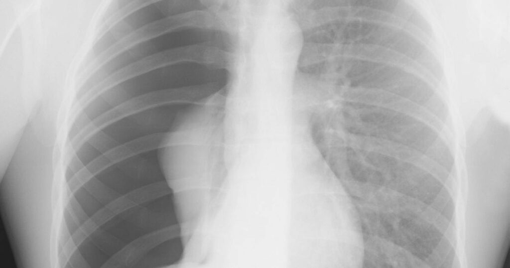 Pneumothorax Types