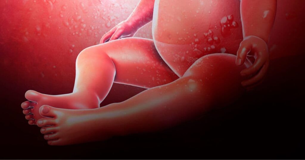 Amniotic Fluid Embolism